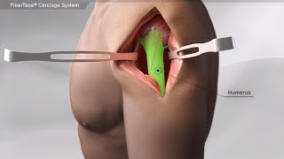 FiberTape<sup>®</sup> Cerclage System Videos