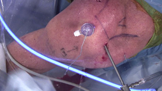 Posterosuperior Rotator Cuff Tears: Knotless Double-Row Repair Videos