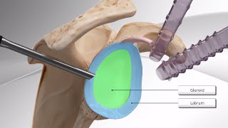 Knotless SutureTak<sup>®</sup> Instability Repair Videos