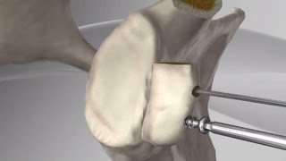 Latarjet for Instability Videos