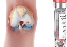 Matrix Associated Cartilage Implantation