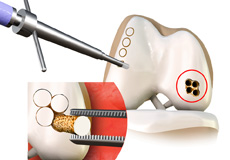 Osteochondral allograft and autograft (OATS)