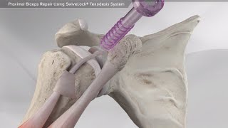 Proximal Biceps Repair Using SwiveLock<sup>®</sup> Tenodesis System Videos
