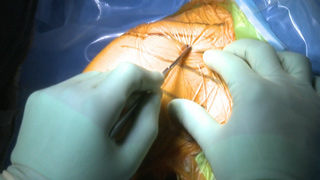 Proximal Humerus Fracture Videos