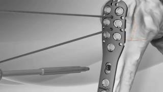 Proximal Humerus Fracture Repair with Arthrex<sup>®</sup> SuturePlate<sup>™</sup> Videos