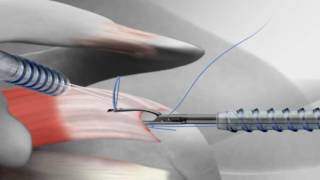 Rotator Cuff Repair with Arthrex<sup>®</sup> SutureBridge<sup>™</sup> Videos