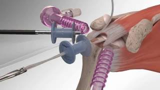 Rotator Cuff Repair with SpeedBridge<sup>™</sup> Technique Videos