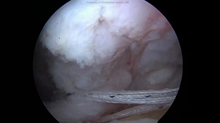 Subscapularis Tendon Tears Videos