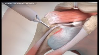 Subscapularis SpeedFix<sup>™</sup> Technique Videos