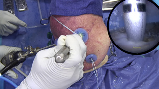 Posterosuperior Rotator Cuff Tears: Superior Capsular Reconstruction Videos