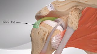 Superior Capsular Reconstruction Videos