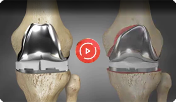Total Knee Replacement Video