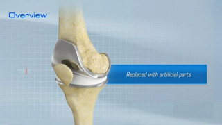 Total Knee Replacement