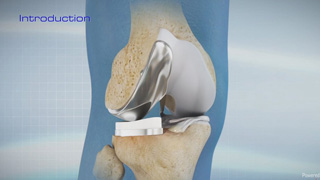 Uni Knee Replacement