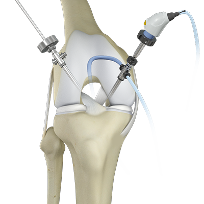 ACL Tear