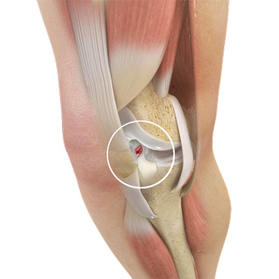 ACL tears and reconstruction