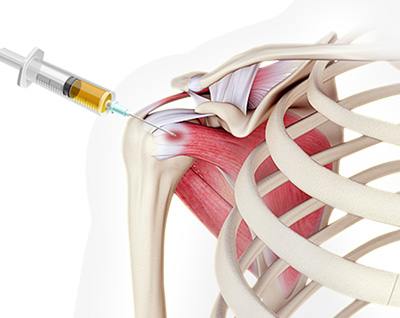 BMAC for Shoulder Conditions