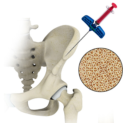 BMAC (Bone Marrow Aspirate Concentrate)
