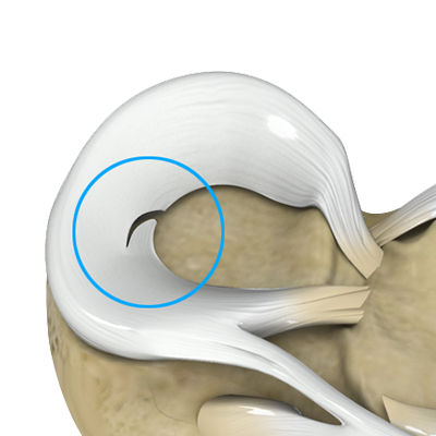Meniscus Tear