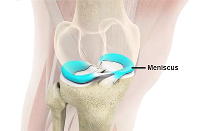 Meniscus tears and knee arthroscopy