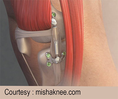 MISHA Implant