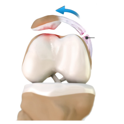 MPFL tears and patellar instability