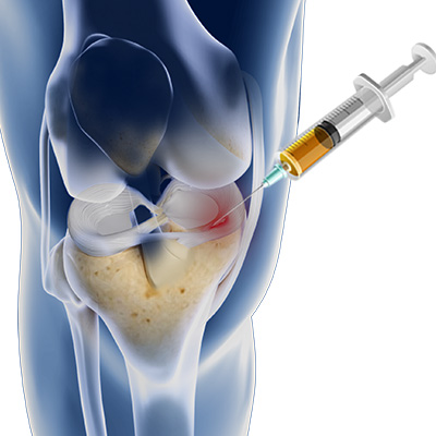 PRP for meniscus tears