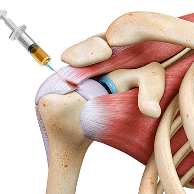 PRP for rotator cuff tears