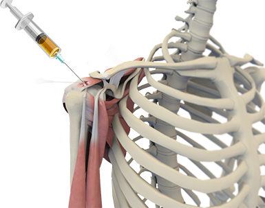 PRP for Rotator Cuff Tears