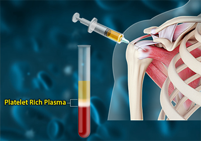 PRP Injections