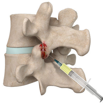 PRP injections treatment