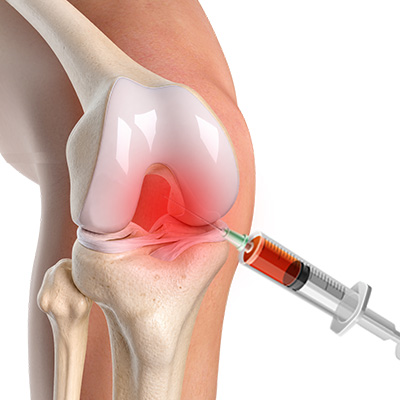 Regenerative Treatments for the Knee