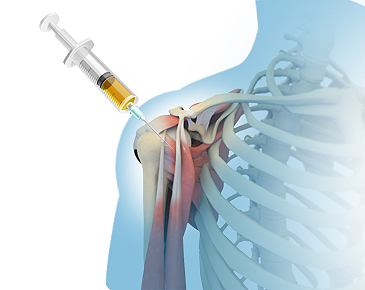 Regenerative Treatments for the Shoulder