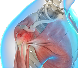 Rotator cuff tear and repair