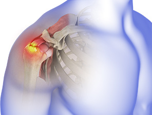 Rotator cuff tear and repair