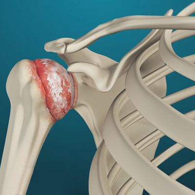 Shoulder Replacement