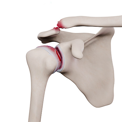 Shoulder arthritis and shoulder replacement