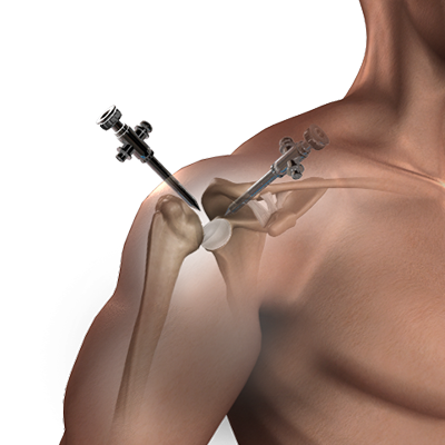 Labral Tear