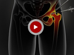 Patient Education Videos of Mr. Viju K Peter Liverpool Hip & Knee Clinic