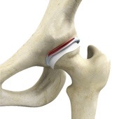Hip Labral Repair