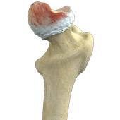 Hip Osteonecrosis