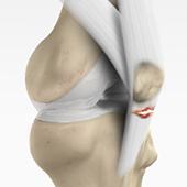 Patellar Tendon Rupture