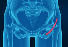 Picture of Anterior Total Hip Replacement