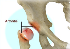 Picture of Arthritis of the Hip