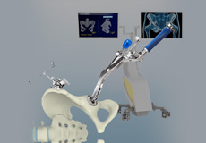 Picture of Computer-Navigated Total Hip Replacement