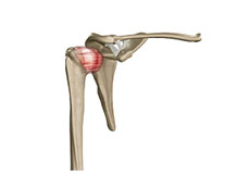 Picture of Frozen Shoulder