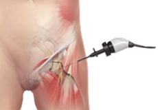Picture of Hip Arthroscopy
