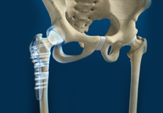 Picture of Hip Fracture Surgery