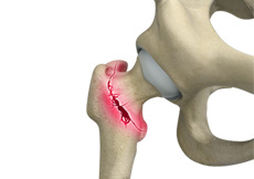 Picture of Hip Fracture