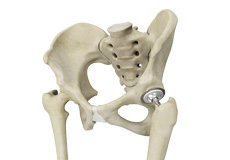 Picture of Total Hip Replacement